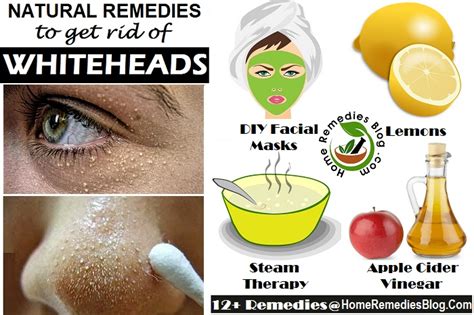 How To Get Rid Of Whiteheads Fast 14 Natural Ways Home Remedies Blog