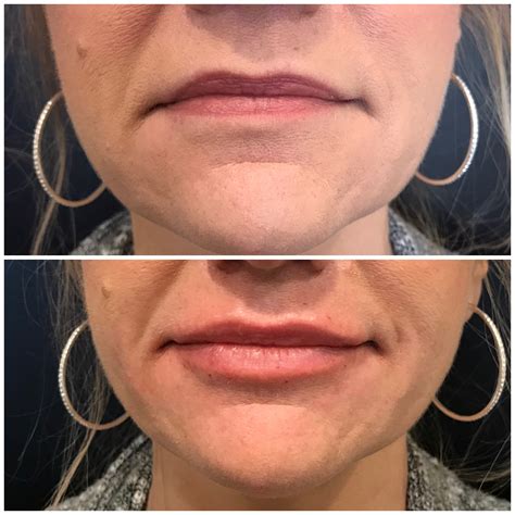 Lip Enhancement Doctor In Lima Oh