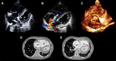 Imaging Of Atrial Septal Defects Echocardiography And Ct Correlation