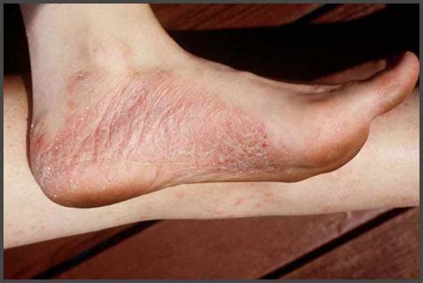 Psoriasis On Ankles Pictures Psoriasis Expert