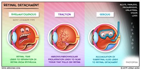 Retinal Detachment Detachment Medical Mnemonics Practical Nursing