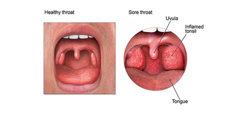 Sore Throat Antibiotic Use Cdc