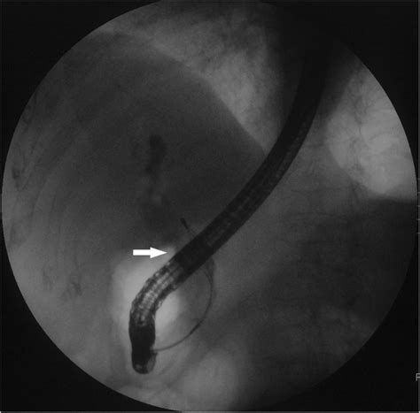 Obstructive Jaundice Due To A Blood Clot After Ercp A Case Report And