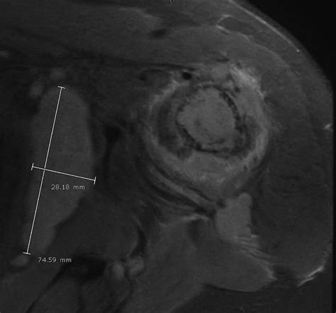 Mri Of The Left Shoulder Coronal View Shows A Large Tumor Replacing
