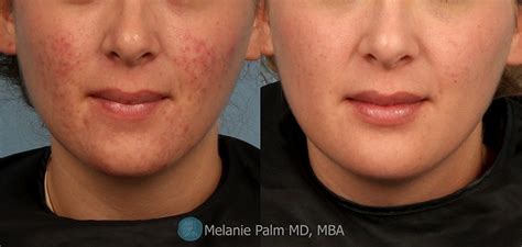 Acne Scarring Before And After Acne Scarring Treatment