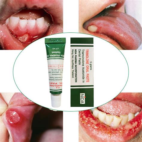 1pcs Oral Care Mouth Ulcer Relief Gel Natural Herbal Oral Antibacterial