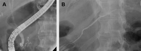 The Role Of Endoscopic Retrograde Cholangiopancreatography In