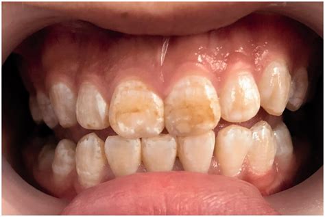 Frontal Photograph Before Whitening Treatment The Tooth Surface Index