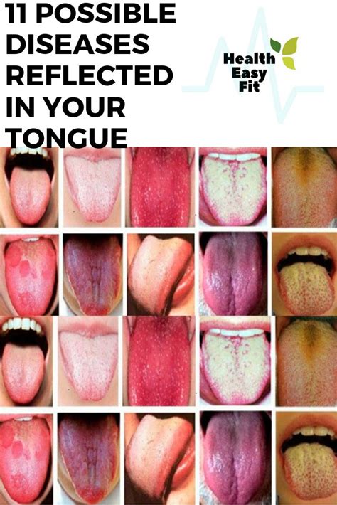 11 Possible Diseases Reflected In Your Tongue Tongue Health Health