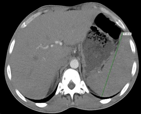 Ct Abdomen Showing Enlarged Spleen Measuring 141 Cm Download