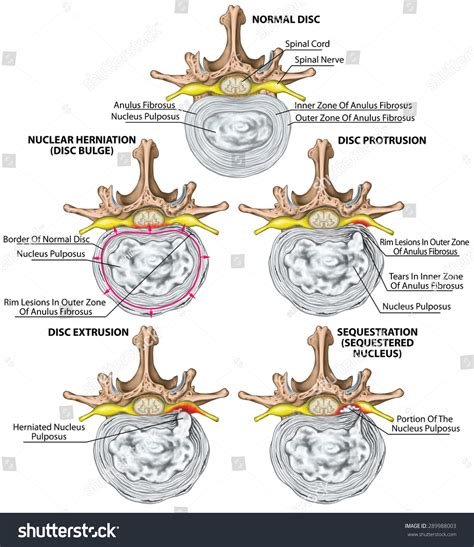 Types Stages Lumbar Disc Herniation Herniated Stock Illustration