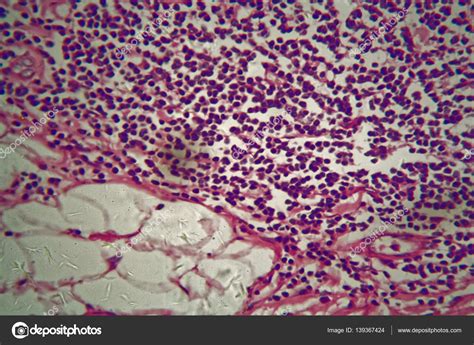 Types Of Cancer Cells Under Microscope