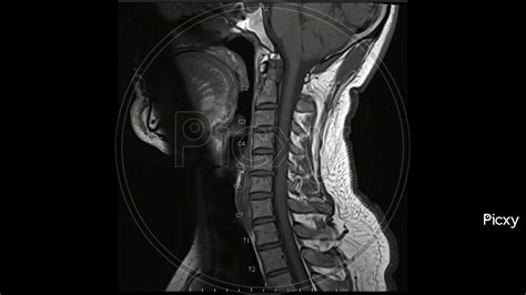 Image Of Magnetic Resonance Images Of Cervical Spine Sagittal T1