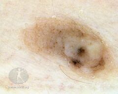 Category Supernumerary Nipple Images Nc Commons