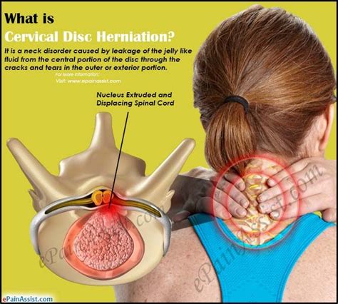 What Is Cervical Disc Herniation How Is It Treated Hot Sex Picture