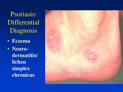 Ppt Overview Of Psoriasis Powerpoint Presentation Free Download Id