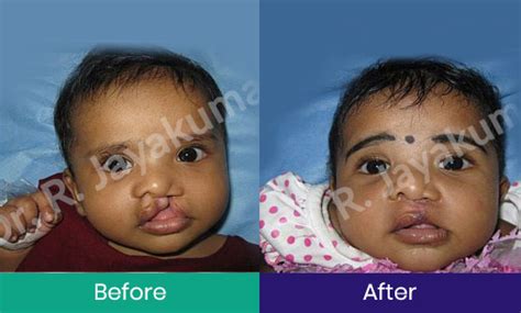 Cleft Lip And Palate Repair Kochi Cleft Lip And Palate Surgery Kerala