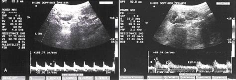 Duplex Doppler Ultrasound Images Of The Left Renal Artery A And The