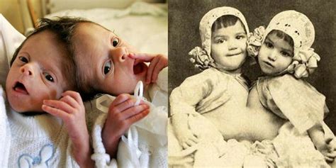 15 Haunting Pics Of Siamese Twins That Will Leave You Speechless