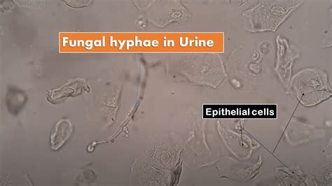 Fungal Hyphae And Plenty Of Epithelial Cells In Urine Microscopy Youtube