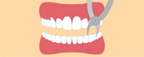 Parodontitis (zahnfleischerkrankung) was beim zahn ziehen zu erwarten ist. Zahn ziehen | Alles was Sie wissen müssen | 360°zahn