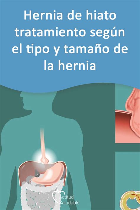 Hernia de hiato tratamiento según el tipo y tamaño de la hernia Hernia de hiato Hernia Hiato