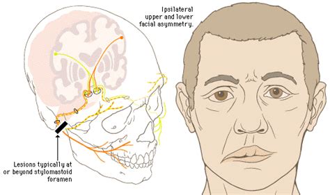 The nerve becomes inflamed and swollen and stops functioning properly. Medical Pictures Info - Bell's Palsy