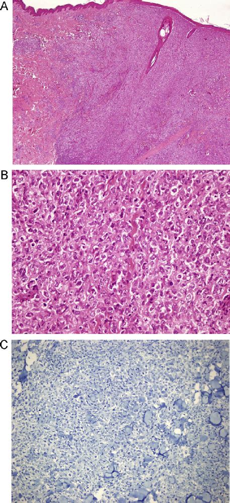 Primary Cutaneous Follicle Center Lymphoma Diffuse Dermal Infiltration