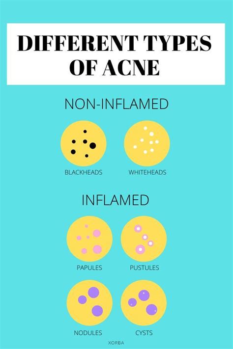 Different Types Of Acne And How To Treat It And How To Treat Each Kind