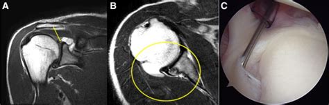 Arthroscopic Allintraarticular Decompression And Labral Repair Of