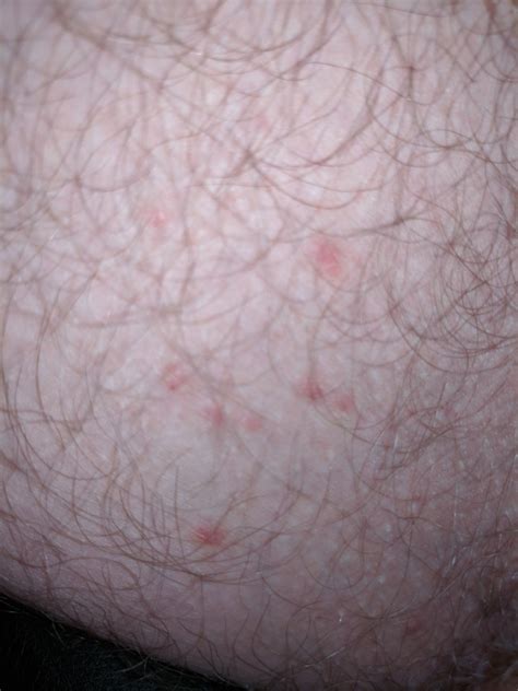 Why Do I Keep Getting Rashes On My Inner Thighs