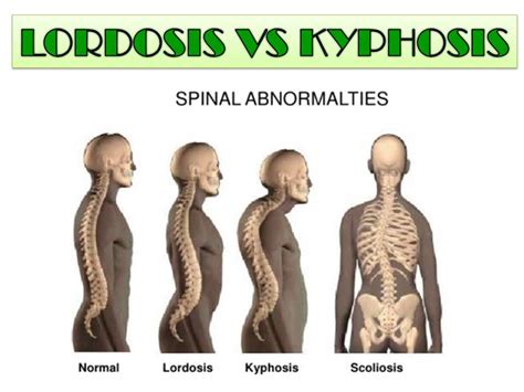 Difference Between Kyphosis And Lordosis Hot Sex Picture