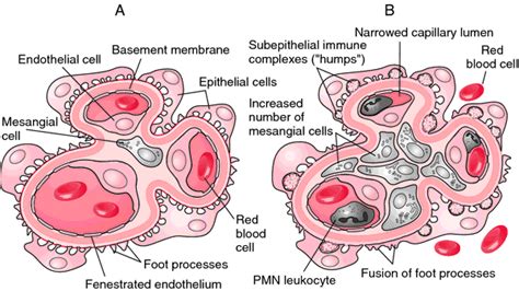 Medical Pg Question Bank Membranoproliferative Glomerulonephritis