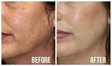 Images of South Korean Acne Scar Treatment