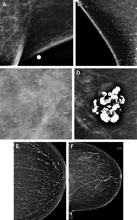 Screening Imaging And Image Guided Biopsy Techniques For Breast