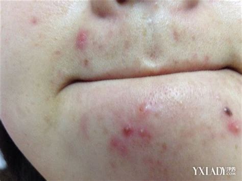 【图】嘴附近长痘痘是什么原因？ 4个重要原因告诉患者嘴附近长痘痘是什么原因伊秀美容网