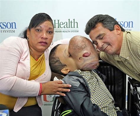 Emanuel Zayas Boy Who Had Large Face Tumor Removed Dies
