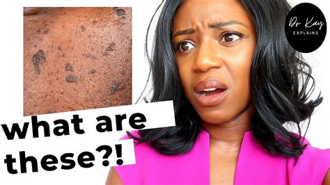 What Is Dermatosis Papulosa Nigra In Black Skin Dr Kay Explains Youtube
