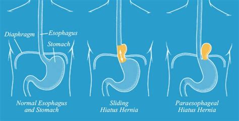 Image Result For Paraesophageal Hernia Hiatus Hernia Image Map
