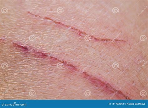 Shallow Inflamed Scratches On Human Skin Stock Image Image Of Danger