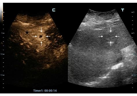 Pyogenic Liver Abscess Contrast Enhanced Ultrasound Allows Morpho
