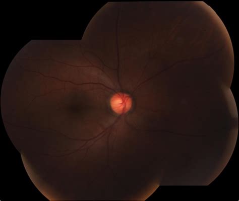 Figure 4 Normal Fundus 2 Months Later After Beginning Of Intermediate