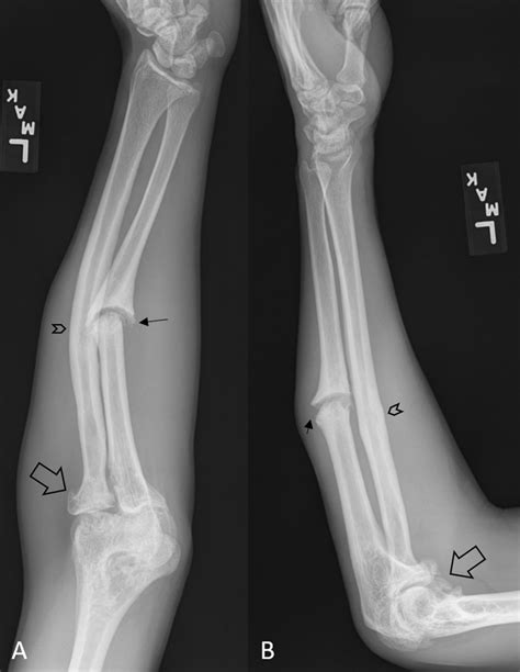 Non Union Ulnar Fracture As A Result Of A Remote Injury Bmj Case Reports