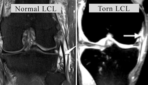 Major pain and tenderness at the inside of the knee; Lateral Collateral Ligament (LCL) treatment | Dr.Raj Kanna