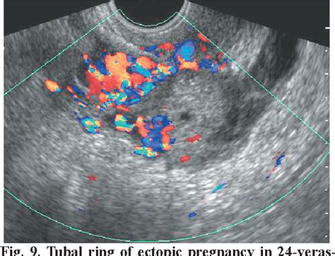 Figure 9 From TUBAL RING SIGN OF ECTOPIC PREGNANCY VERSUS CORPUS LUTEUM