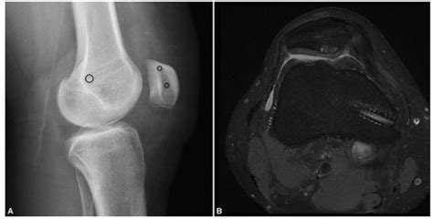 Medial Patellofemoral Ligament Reconstruction Using Suture Anchors