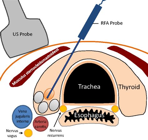 Thyroid Rfa Vs Conventional Thyroidectomy