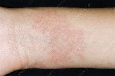 Eczema On The Wrist Stock Image C0069161 Science Photo Library