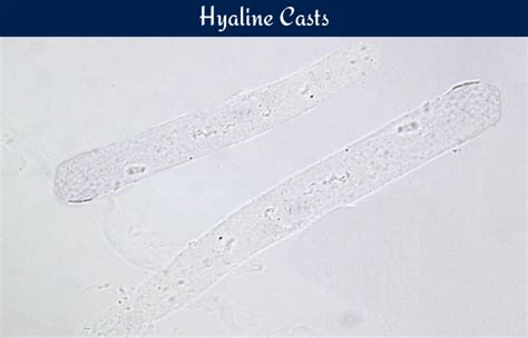 Hyaline Cast In Urine