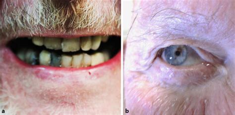 Figure 1 From Minocycline Induced Hyperpigmentation In A Patient